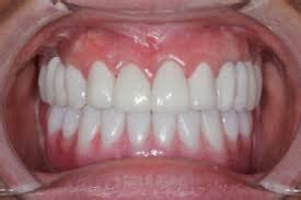 What Are Permanent Teeth Implants? – Dentistry Courses