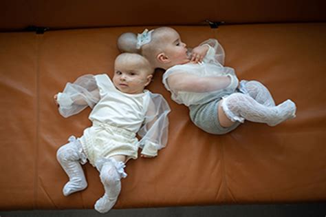 nine-month-old conjoined twins by head separated successfully