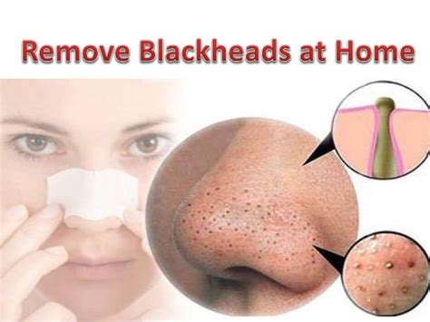 How to Remove Blackheads From Nose