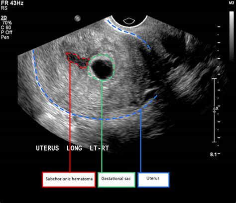 Effects of subchorionic haematoma on pregnancy outcomes | Australian Medical Student Journal