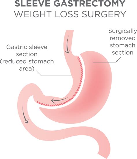 Gastric Sleeve Surgery Near Johnstown and Windber - Chan Soon-Shiong Medical Center at Windber