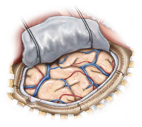 Acute Subdural Hematoma | The Neurosurgical Atlas