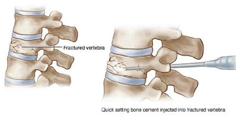 Percutaneous vertebroplasty offers hope in spinal fracture cases