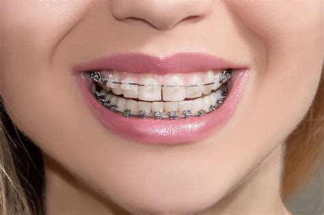 Your Visual Guide to Different Types of Braces | Langley Braces | Aura Orthodontics