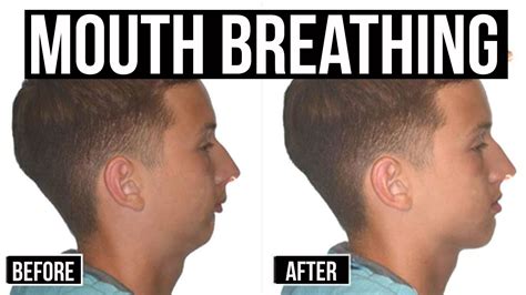 Fix Your Tongue Posture and Mouth Breathing for Better Sleep, More Energy and Better Health