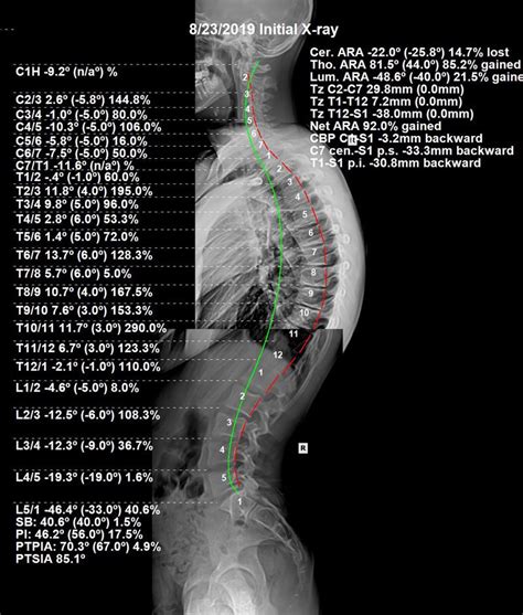 What is Kyphosis? - ScoliTech - Scoliosis Doctor in Edina, MN