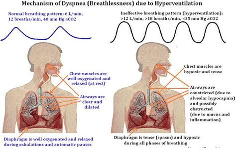 What is Dyspnea : Definition, Symptoms, Causes & Treatment