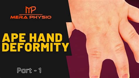 Ape Hand Deformity - part 1 | Introduction | In Hindi | Mera Physio ...