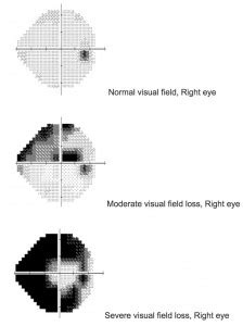 Glaucoma Tests and Diagnosis - Glaucoma Associates of Texas