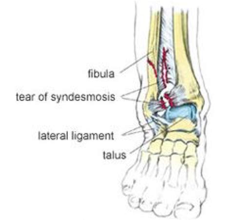 Recurrent Ankle Injuries and Balance Training — Brookvale Physio | HPRS ...