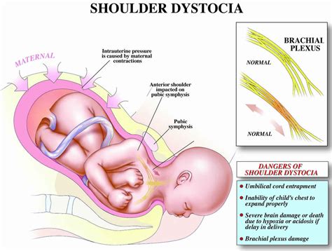 Shoulder dystocia, causes, signs, diagnosis, treatment, maneuvers ...