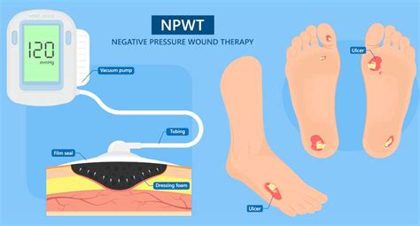 Negative Pressure Wound Therapy: Benefits and Application