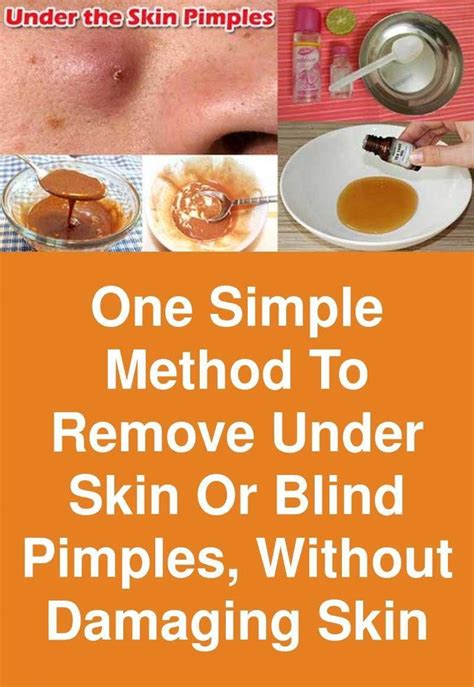 One simple method to remove under skin or blind Pimples, without ...