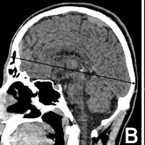 Length measurements MR images in three plane. a: Foramen magnum length ...