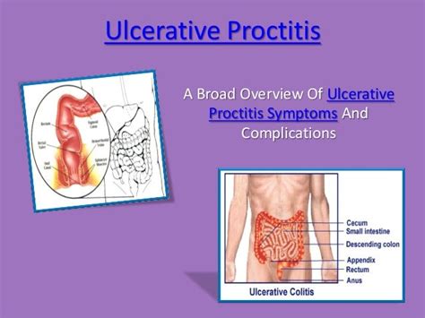 Ulcerative proctitis