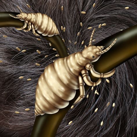 All Kinds Of Essential Details About The Super Lice Treatment - WebSta.ME