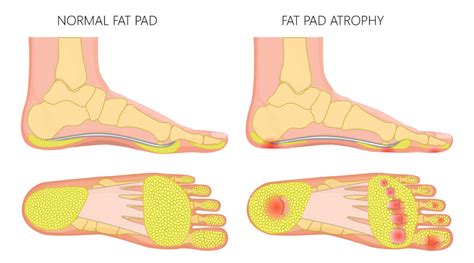 Heel Fat Pad Syndrome [Causes, Symptoms, Diagnosis & Treatment]