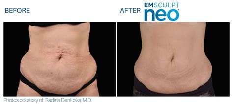 Emsculpt NEO Before and After | Real Patient Results