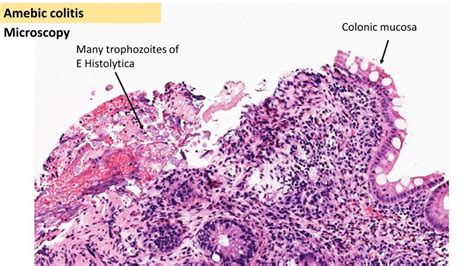 PATHOLOGY OF AMEBIC COLITIS - Pathology Made Simple