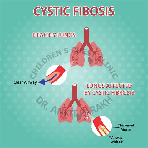 Lung problems in Cystic Fibrosis - symptoms and causes - Dr. Ankit Parakh