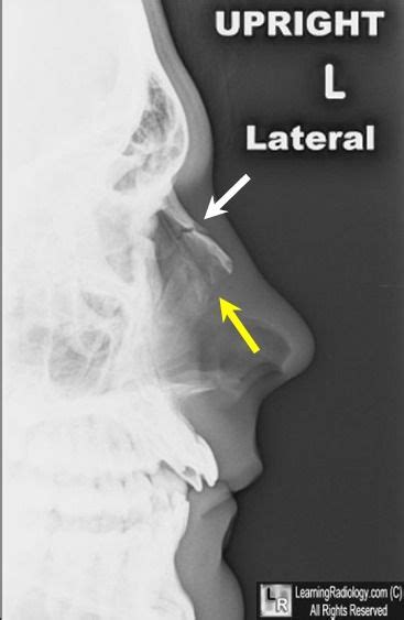 Nasal fractures may not be evident on plain films One suture line should normally be visible at ...