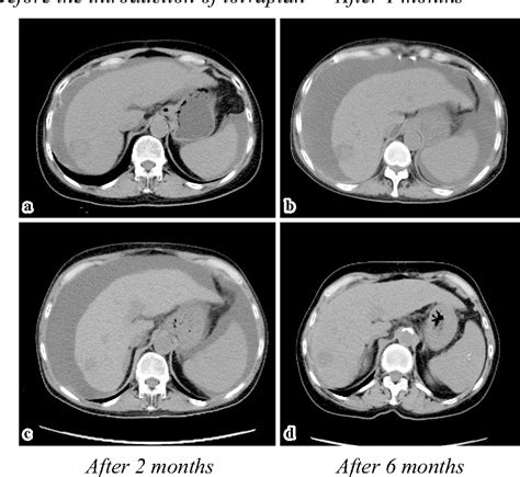 Figure 1 from Cases with Refractory Ascites and a Delayed Response to ...