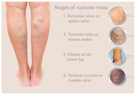 What Are Reticular Veins? | The Vein Institute