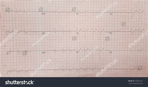 22 Retrograde P Wave Images, Stock Photos & Vectors | Shutterstock