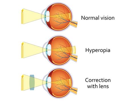 Top Eye Specialists in Kerala | Refractive Error- Hyperopia