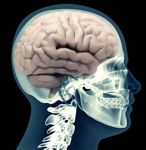 Intracerebral hemorrhage: Symptoms, risk factors, and treatment