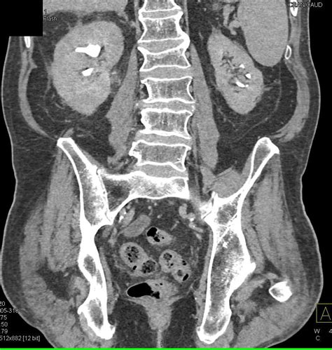 Striated Nephrograms and Acute Pyelonephritis Right Kidney - Kidney Case Studies - CTisus CT ...