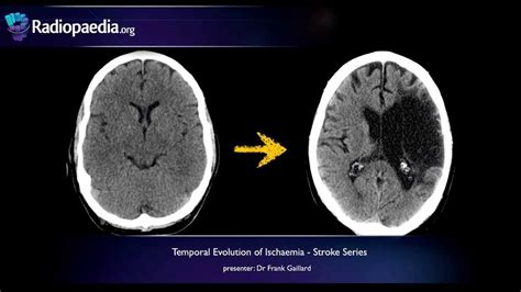 Stroke: Evolution from acute to chronic infarction - radiology video tutorial (CT, MRI) - YouTube