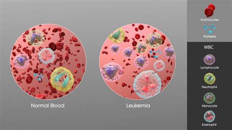 Leukemia - Physiopedia