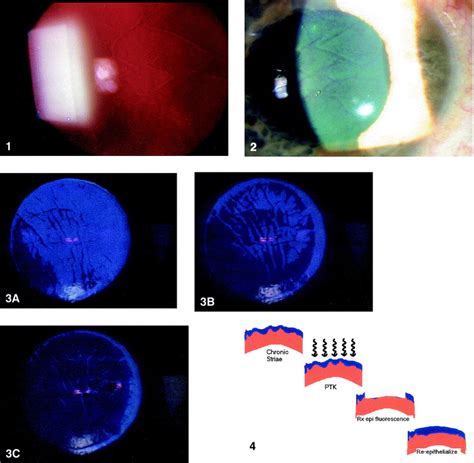 Results of phototherapeutic keratectomy in the management of flap striae after LASIK - Ophthalmology