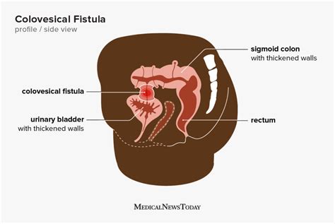 Colovesical fistula: What occurs, symptoms, and causes