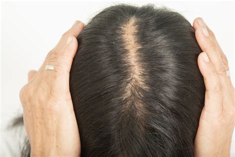 Intradermal Minoxidil Injections for the Treatment of Androgenetic Alopecia in Women ...