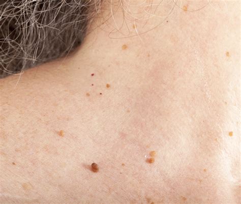 Skin Tag Removal Manchester, Cheshire & Lancashire | Dr Nicole Dermatology