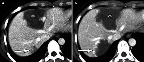 Benign Liver Tumors | Radiology Key