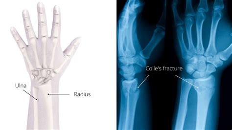 Dummies Guide to Colles' fracture Exercise After Cast Removal