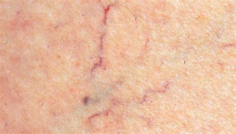 Spider veins: Causes, treatment, and prevention