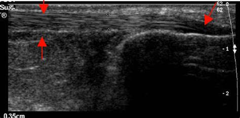 Ultrasound for Achilles Tendon Rupture - emdocs