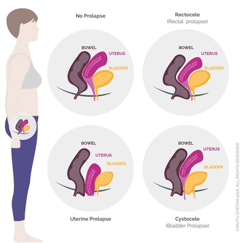 Understanding pelvic organ prolapse (and why kegels aren't enough)