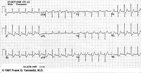 ECG Learning Center - An introduction to clinical electrocardiography