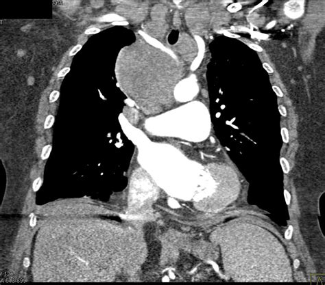 Lymphoma Involves the Mediastinum - Chest Case Studies - CTisus CT Scanning