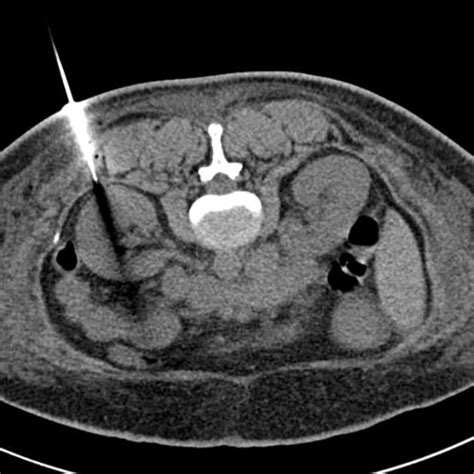 CT guided renal biopsy | Radiology Case | Radiopaedia.org | Renal, Radiology, Kidney biopsy