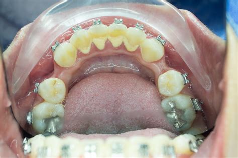 Experiencing gingivitis with braces | gilberter.com