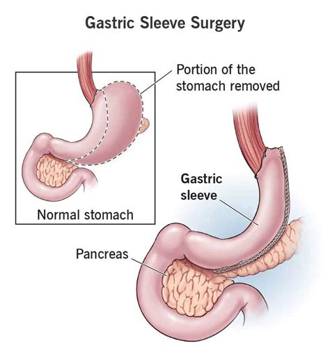 Laparoscopic Gastric Sleeve Surgery - ASTRAMEDICA