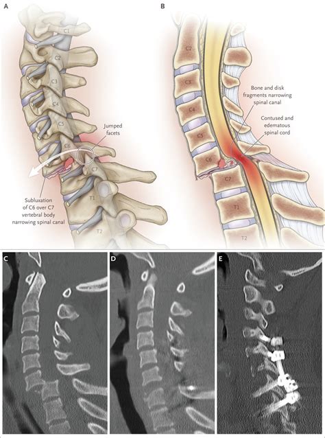 Spinal Cord Compression