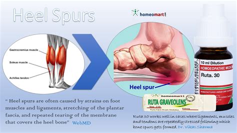 Posterior heel spur treatment options including alternative remedies