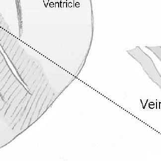 Schematic illustration of the occlusion technique. After exposing the ...